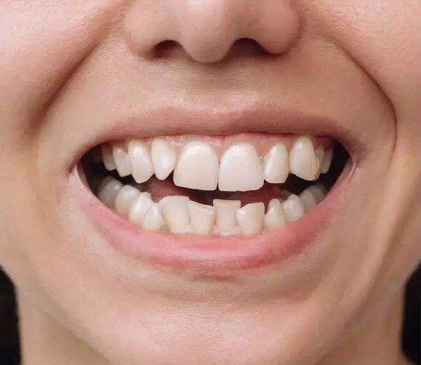 Before – Bite Alignment