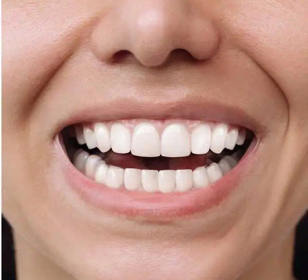 After – Bite Alignment