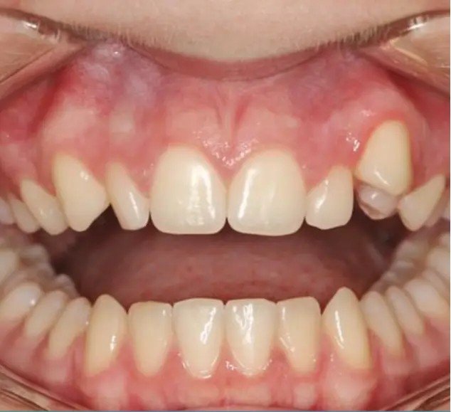 Before – Invisalign Alignment
