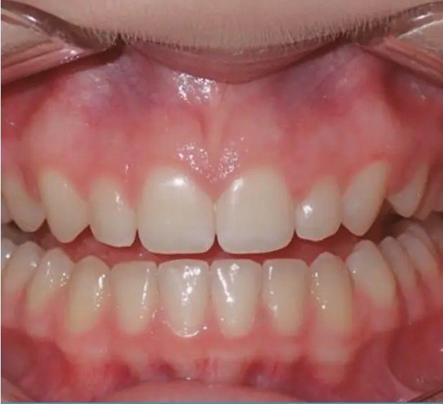 After – Invisalign Alignment