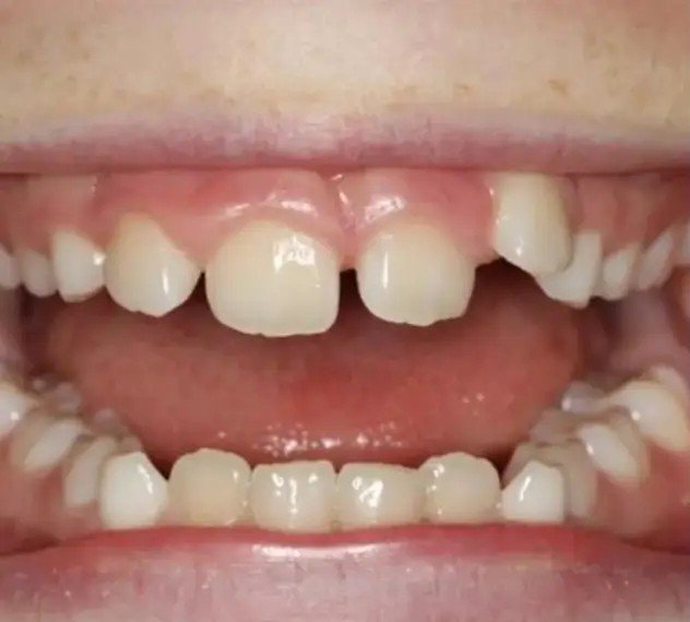 Before – Gap Closure