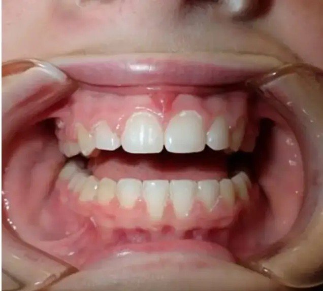 After – Gap Closure